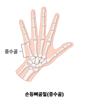 손등뼈 골절(중수골)