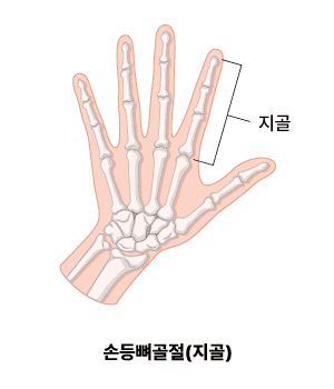 손가락 골절(지골)