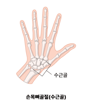 손목뼈 골절(수근골)