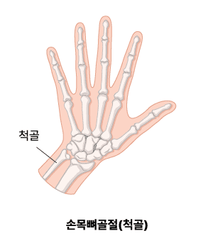 손목뼈 골절(척골)