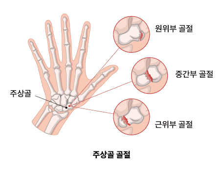 주상골 골절