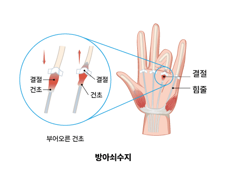 방아쇠수지