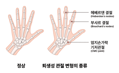 류마티스관절염