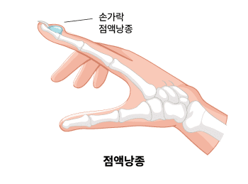 점액낭종