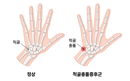 척골충돌증후군