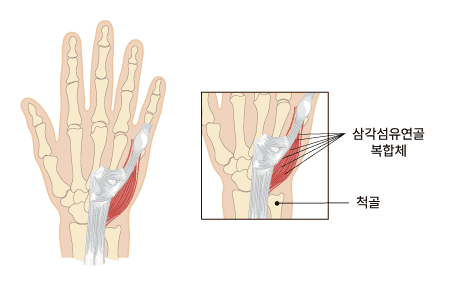 삼각섬유연골복합체 파열