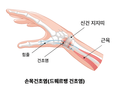 손목건초염