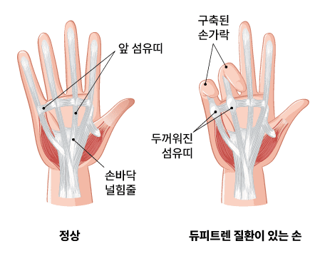 듀피트렌 구축증