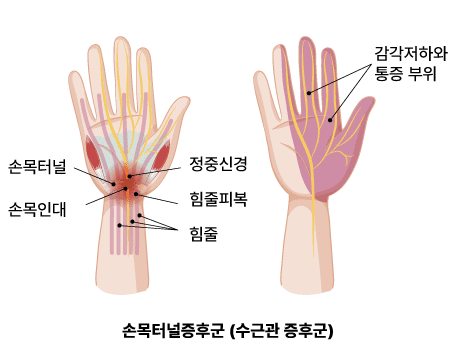 손목터널증후군