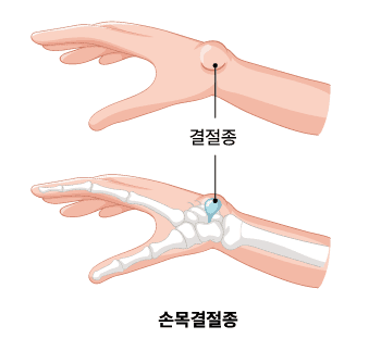 결절종