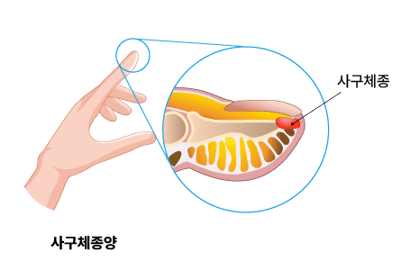 사구체종양