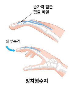 망치형 수지