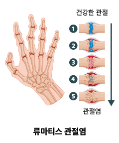 류마티스관절염