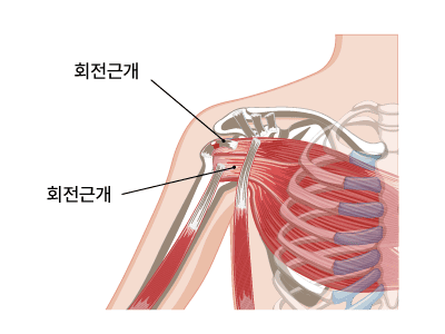 회전근개파열