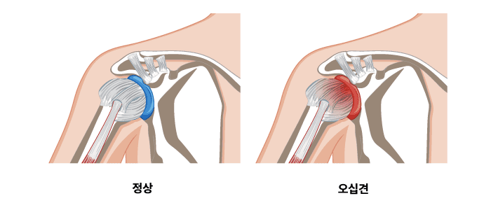 오십견(동결견)