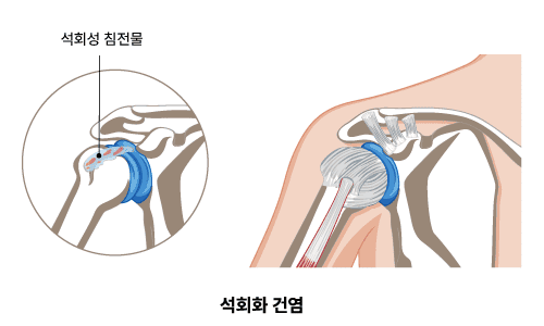 석회화 건염