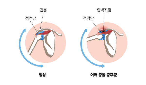 어깨 충돌 증후군