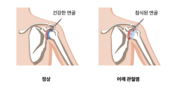 어깨 관절염