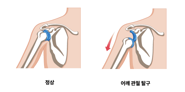 습관성/재발성 탈구