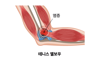 테니스 엘보우