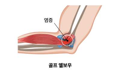 골프 엘보우