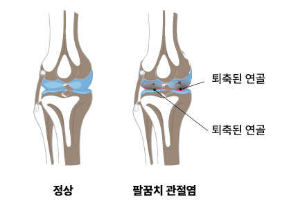 팔꿈치 관절염