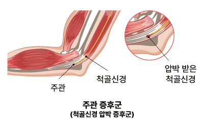 주관 증후군(척골신경 압박 증후군)