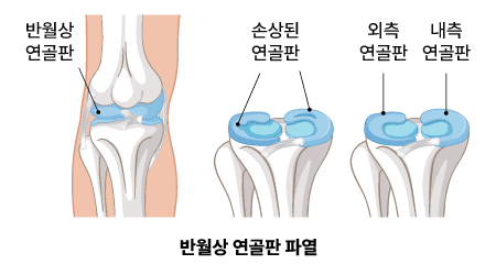 반월상 연골판 파열