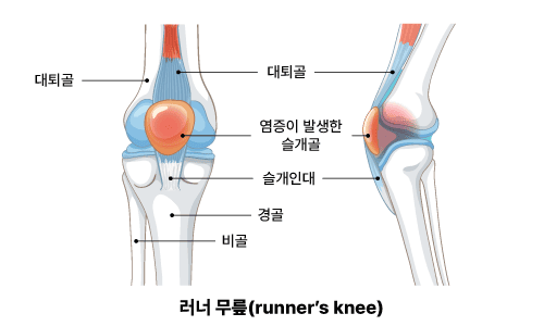 런너 무릎 증후군(슬개 대퇴 동통)