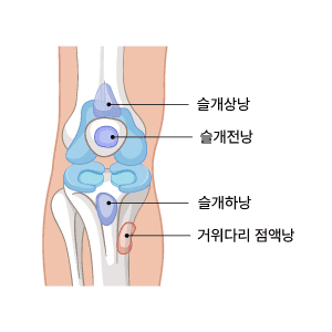 무릎 힘줄의 활액낭염