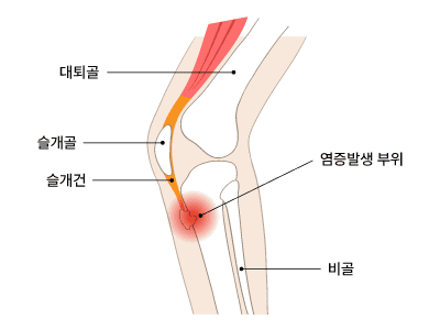 오스굿 슐라터(Osgood Schlater) 질환