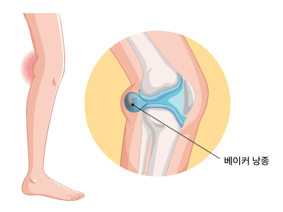 베이커 낭종(Baker's cyst)