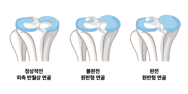 원판형 연골판