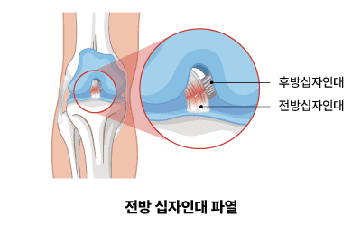 전방 십자인대파열