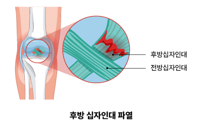 후방 십자인대파열