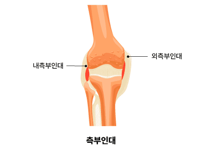 측부인대 파열