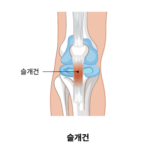 슬개건 파열