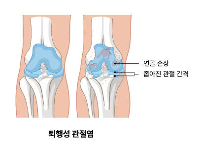 퇴행성 관절염