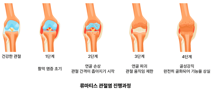 류마티스 관절염