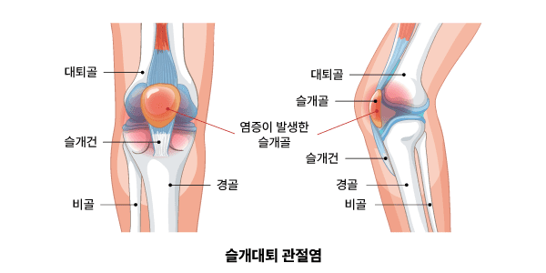 슬개대퇴 관절염