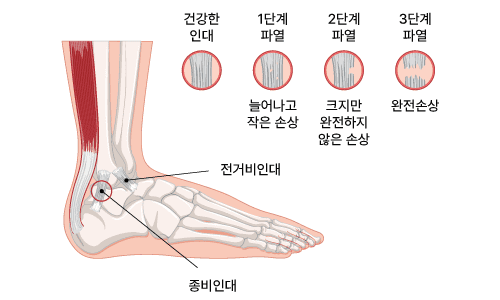 발목 외측 인대 파열