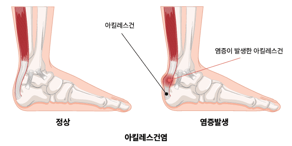 아킬레스건염