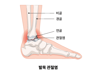 관절염