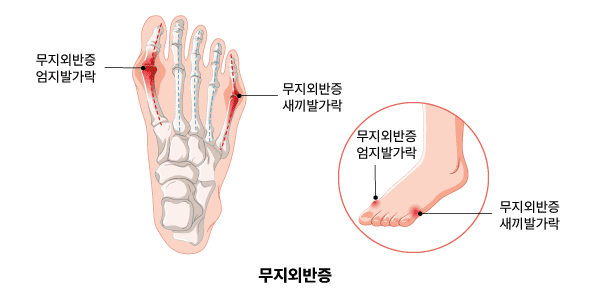 무지외반증