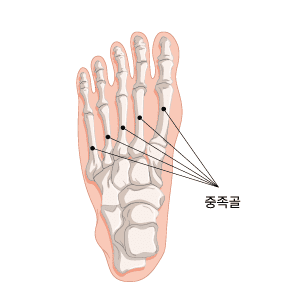 중족골 통증 및 굳은살