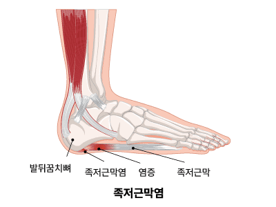 족저근막염