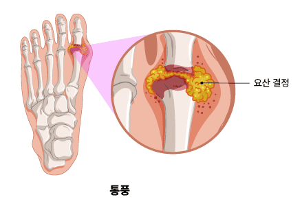 통풍