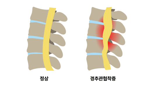 경추관협착증