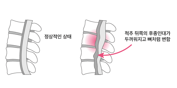 후종인대골화증