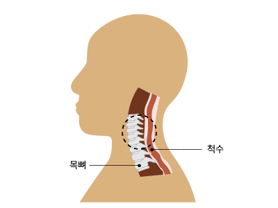 경추 척수증